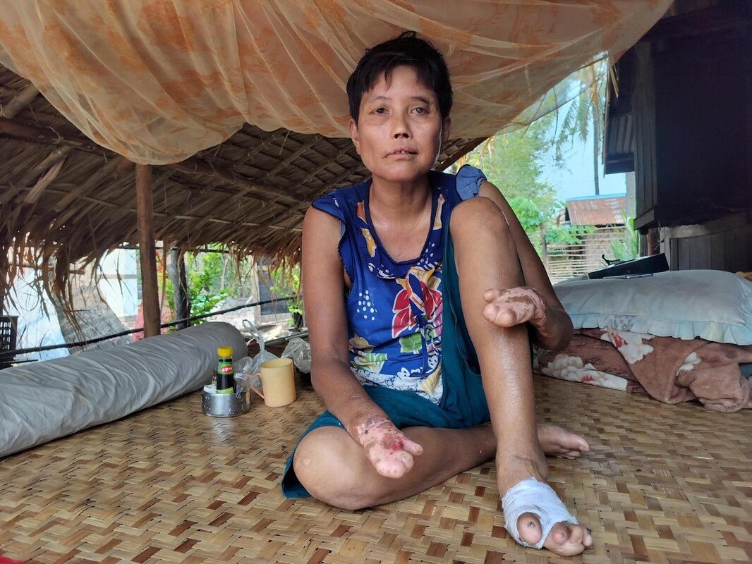 A woman affected by leprosy in her dwelling in Myanmar.